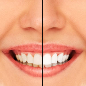 odontoiatria estetica di sbiancamento dentale a Thiene Vicenza